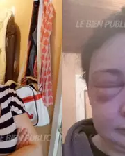 Encore un nouveau cas d'allergie à la coloration, à Dijon !